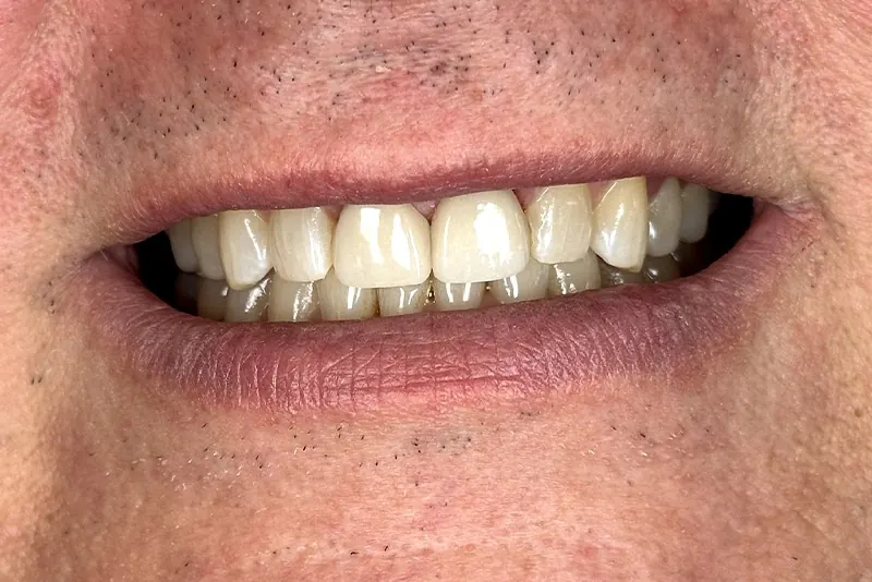 After: new crowns giving an even row of front teeth.