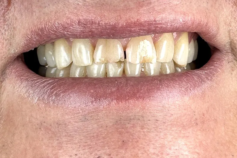 Before: worn, stained upper front teeth with a gap in the middle.