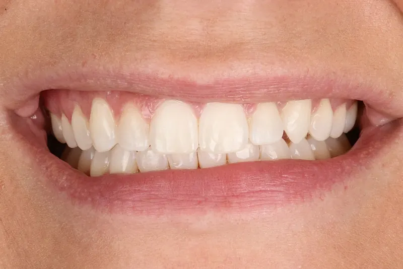 After: the same teeth with the gaps closed by Invisalign.