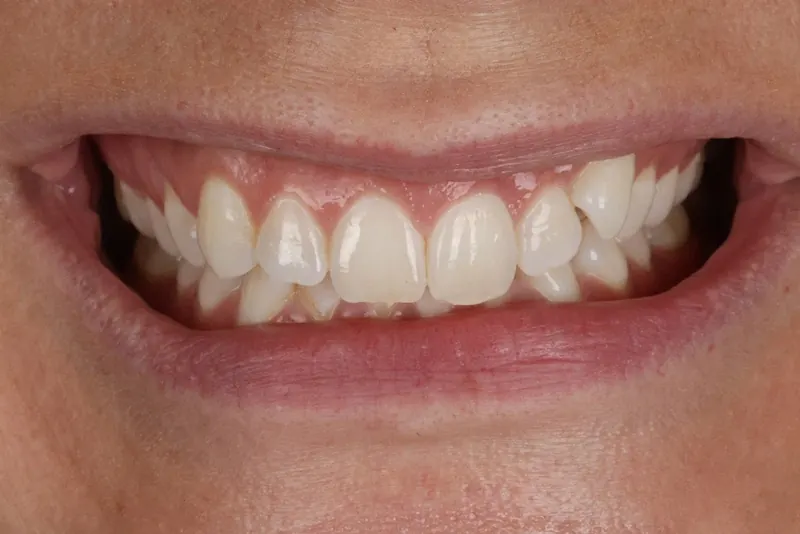 Before: noticeable gaps between the upper and lower front teeth.