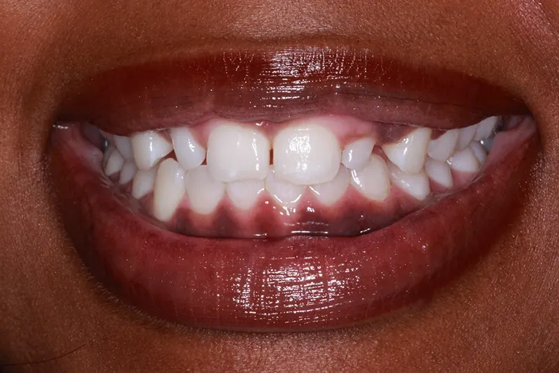 Before: small, crowded upper front teeth.