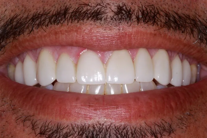 After: the gap closed and the front teeth lengthened with veneers.