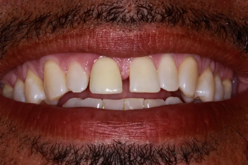 Before: a gap between the two upper front teeth, which are short and worn.
